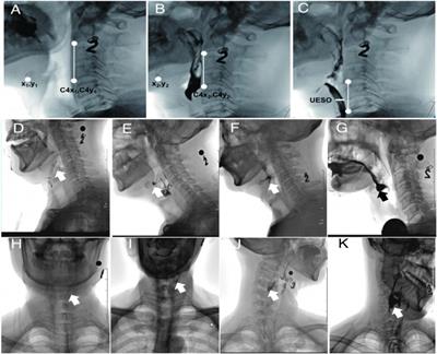 Characteristics of dysphagia among different lesion sites of stroke: A retrospective study